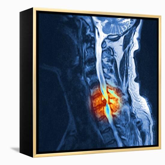 Slipped Disc, MRI Scan-PASIEKA-Framed Premier Image Canvas