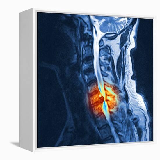 Slipped Disc, MRI Scan-PASIEKA-Framed Premier Image Canvas