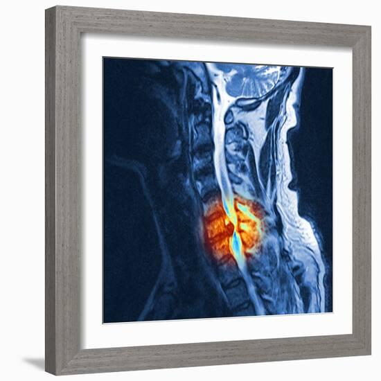 Slipped Disc, MRI Scan-PASIEKA-Framed Premium Photographic Print