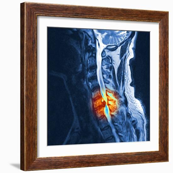 Slipped Disc, MRI Scan-PASIEKA-Framed Premium Photographic Print