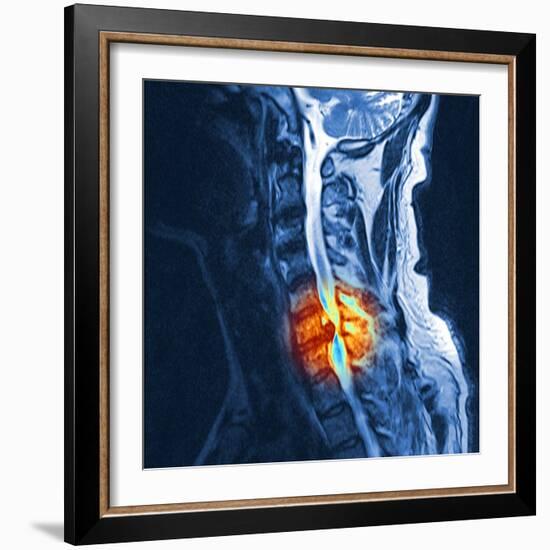 Slipped Disc, MRI Scan-PASIEKA-Framed Premium Photographic Print