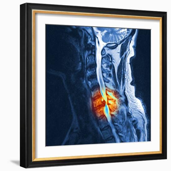 Slipped Disc, MRI Scan-PASIEKA-Framed Premium Photographic Print