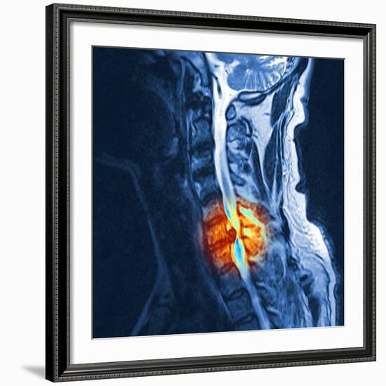 Slipped Disc, MRI Scan-PASIEKA-Framed Photographic Print