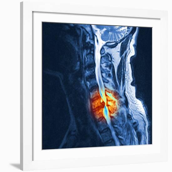 Slipped Disc, MRI Scan-PASIEKA-Framed Photographic Print
