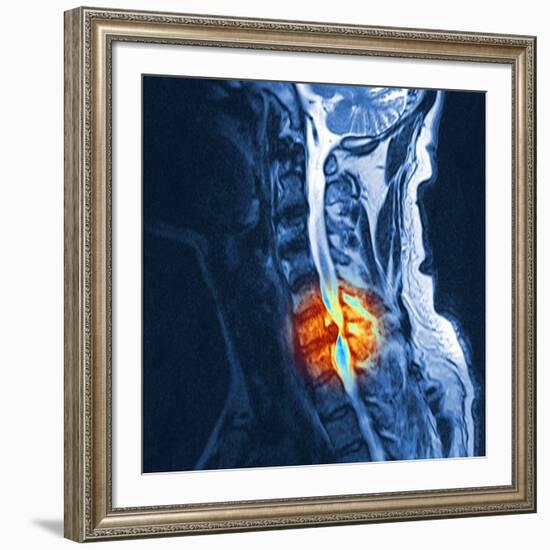 Slipped Disc, MRI Scan-PASIEKA-Framed Photographic Print