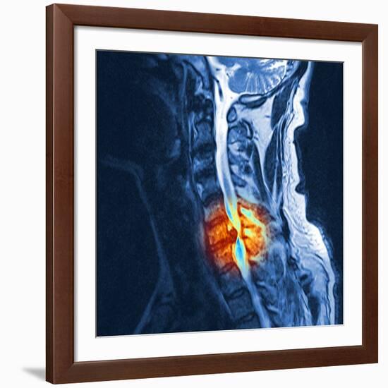 Slipped Disc, MRI Scan-PASIEKA-Framed Photographic Print