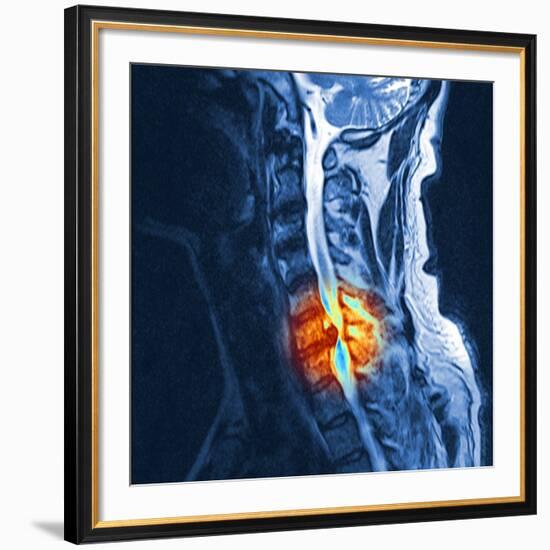 Slipped Disc, MRI Scan-PASIEKA-Framed Photographic Print