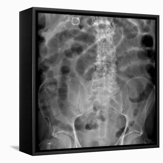 Small Bowel Obstruction, X-ray-Du Cane Medical-Framed Premier Image Canvas