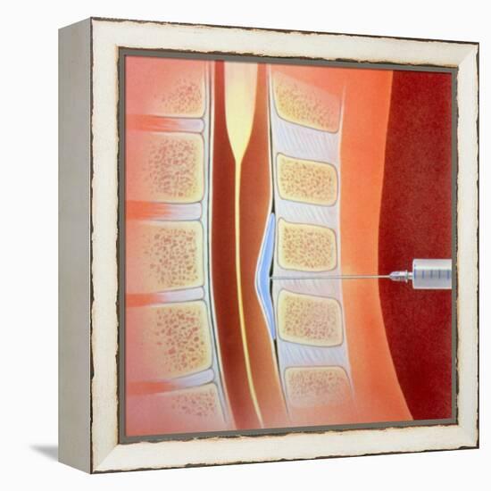 Spinal Epidural Anaesthetic-David Gifford-Framed Premier Image Canvas