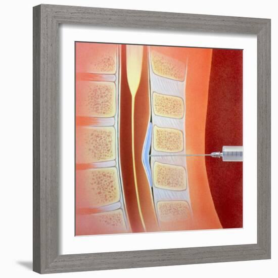 Spinal Epidural Anaesthetic-David Gifford-Framed Premium Photographic Print