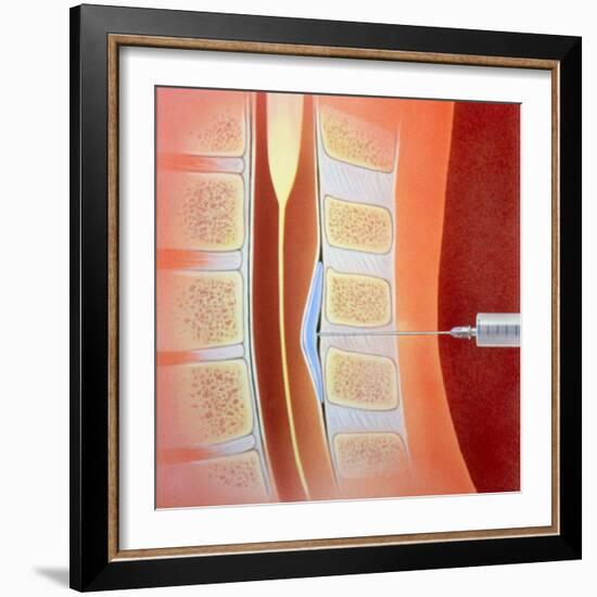 Spinal Epidural Anaesthetic-David Gifford-Framed Premium Photographic Print