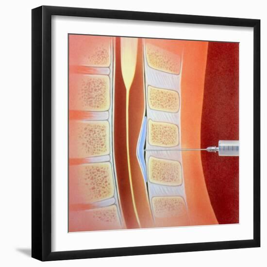 Spinal Epidural Anaesthetic-David Gifford-Framed Premium Photographic Print