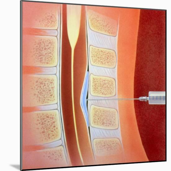 Spinal Epidural Anaesthetic-David Gifford-Mounted Premium Photographic Print