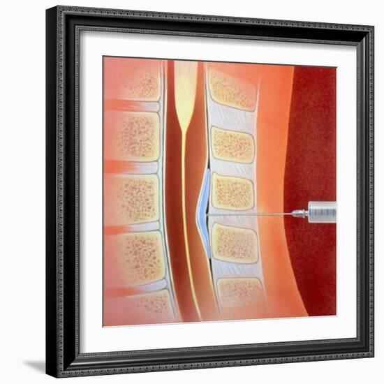 Spinal Epidural Anaesthetic-David Gifford-Framed Premium Photographic Print