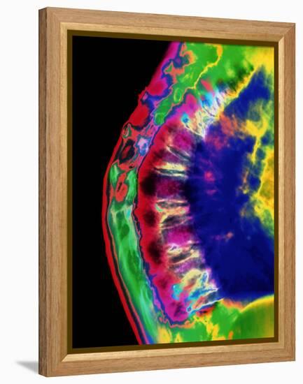 Spinal Osteoporosis-Mehau Kulyk-Framed Premier Image Canvas