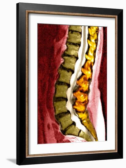 Spine Degeneration, MRI Scan-Du Cane Medical-Framed Photographic Print