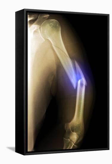 Splintered Arm Fracture, X-ray'-Du Cane Medical-Framed Premier Image Canvas