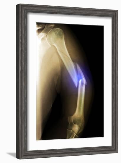 Splintered Arm Fracture, X-ray'-Du Cane Medical-Framed Photographic Print