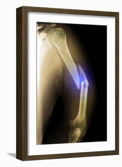 Splintered Arm Fracture, X-ray'-Du Cane Medical-Framed Photographic Print