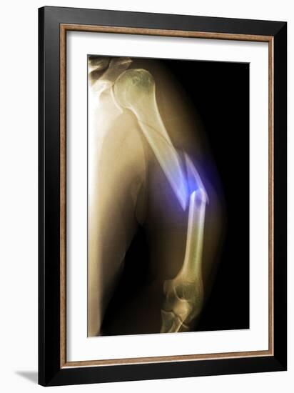 Splintered Arm Fracture, X-ray'-Du Cane Medical-Framed Photographic Print