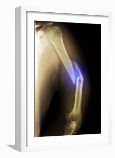 Splintered Arm Fracture, X-ray'-Du Cane Medical-Framed Photographic Print