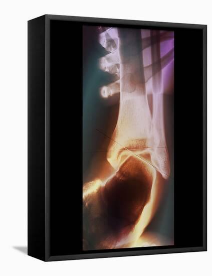 Sprained Ankle, X-ray-ZEPHYR-Framed Premier Image Canvas