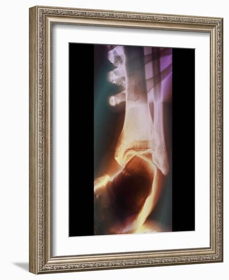 Sprained Ankle, X-ray-ZEPHYR-Framed Photographic Print