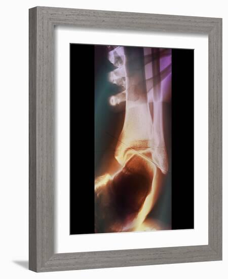 Sprained Ankle, X-ray-ZEPHYR-Framed Photographic Print