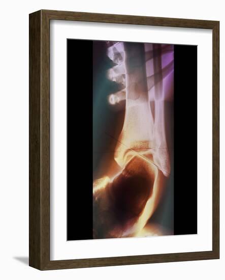 Sprained Ankle, X-ray-ZEPHYR-Framed Photographic Print