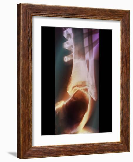 Sprained Ankle, X-ray-ZEPHYR-Framed Photographic Print