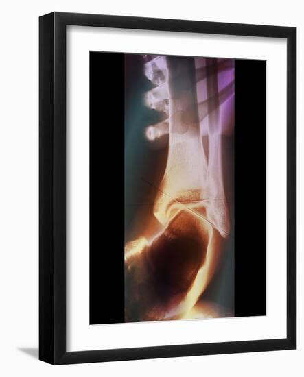 Sprained Ankle, X-ray-ZEPHYR-Framed Photographic Print