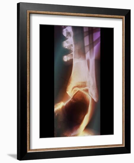 Sprained Ankle, X-ray-ZEPHYR-Framed Photographic Print