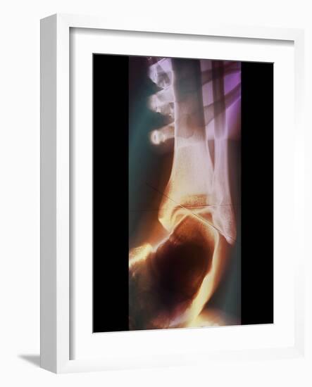 Sprained Ankle, X-ray-ZEPHYR-Framed Photographic Print