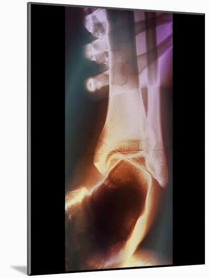 Sprained Ankle, X-ray-ZEPHYR-Mounted Photographic Print