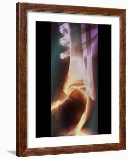 Sprained Ankle, X-ray-ZEPHYR-Framed Photographic Print