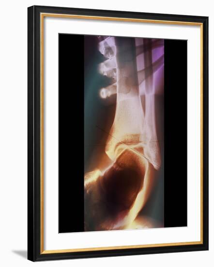 Sprained Ankle, X-ray-ZEPHYR-Framed Photographic Print