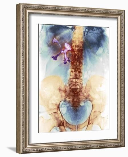 Staghorn Kidney Stone, X-ray-Du Cane Medical-Framed Photographic Print