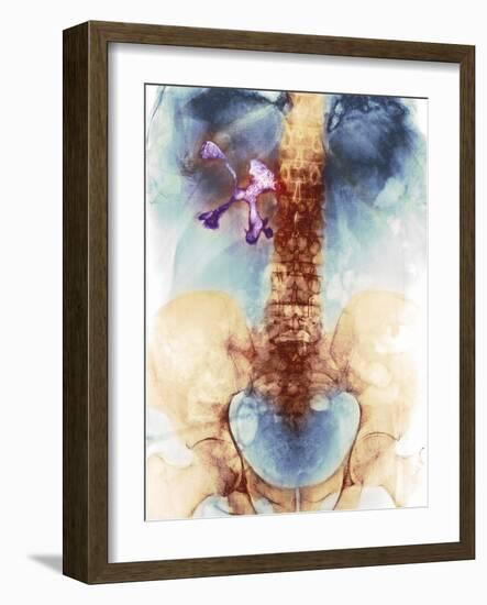 Staghorn Kidney Stone, X-ray-Du Cane Medical-Framed Photographic Print