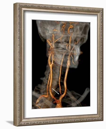 Stenosis of Carotid Artery, CT Scan-ZEPHYR-Framed Photographic Print