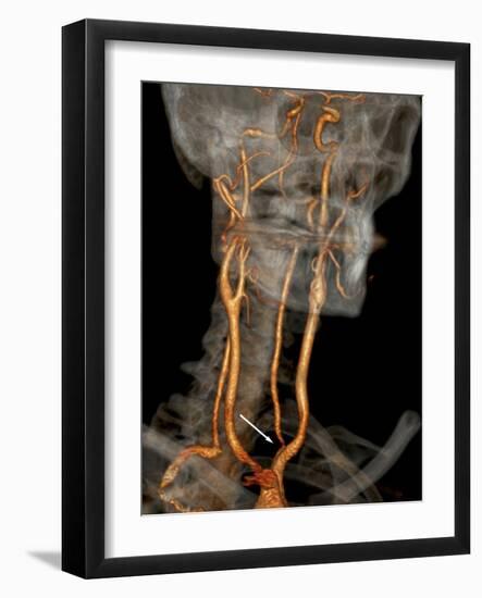 Stenosis of Carotid Artery, CT Scan-ZEPHYR-Framed Photographic Print