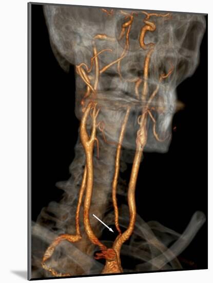 Stenosis of Carotid Artery, CT Scan-ZEPHYR-Mounted Photographic Print
