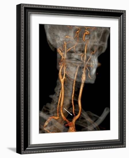 Stenosis of Carotid Artery, CT Scan-ZEPHYR-Framed Photographic Print