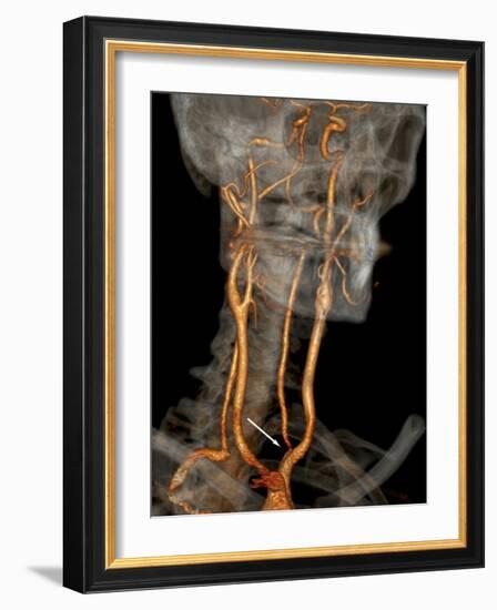 Stenosis of Carotid Artery, CT Scan-ZEPHYR-Framed Photographic Print