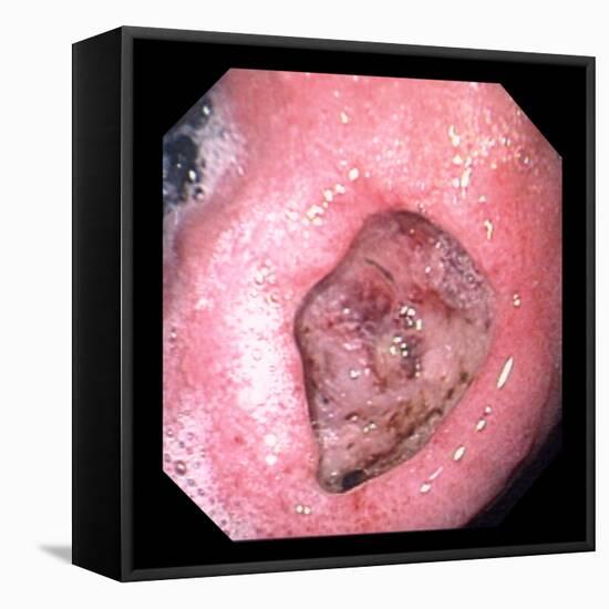 Stomach Ulcer-David Martin-Framed Premier Image Canvas