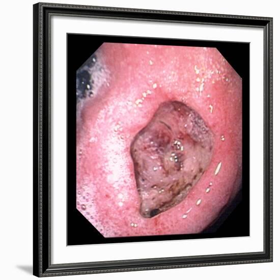 Stomach Ulcer-David Martin-Framed Photographic Print