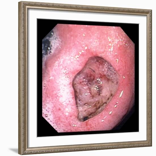 Stomach Ulcer-David Martin-Framed Photographic Print