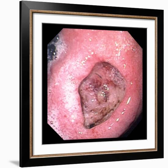 Stomach Ulcer-David Martin-Framed Photographic Print