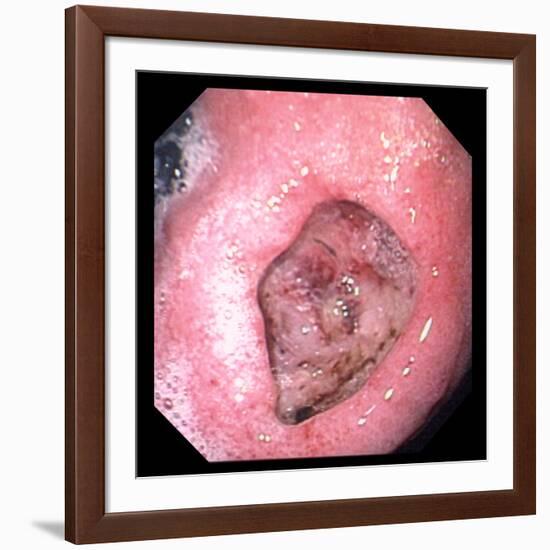 Stomach Ulcer-David Martin-Framed Photographic Print