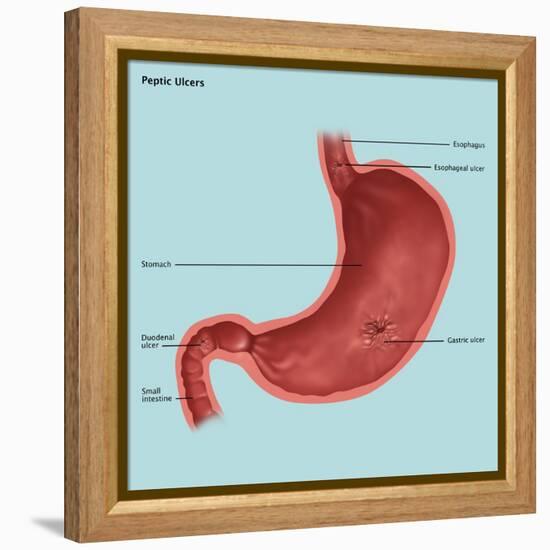 Stomach Ulcers, Illustration-Gwen Shockey-Framed Premier Image Canvas