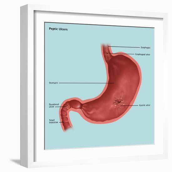 Stomach Ulcers, Illustration-Gwen Shockey-Framed Giclee Print